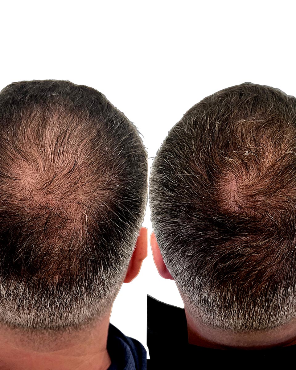 PRP Hair Treatment Perth | Hair Loss – The Lime Tree Clinic