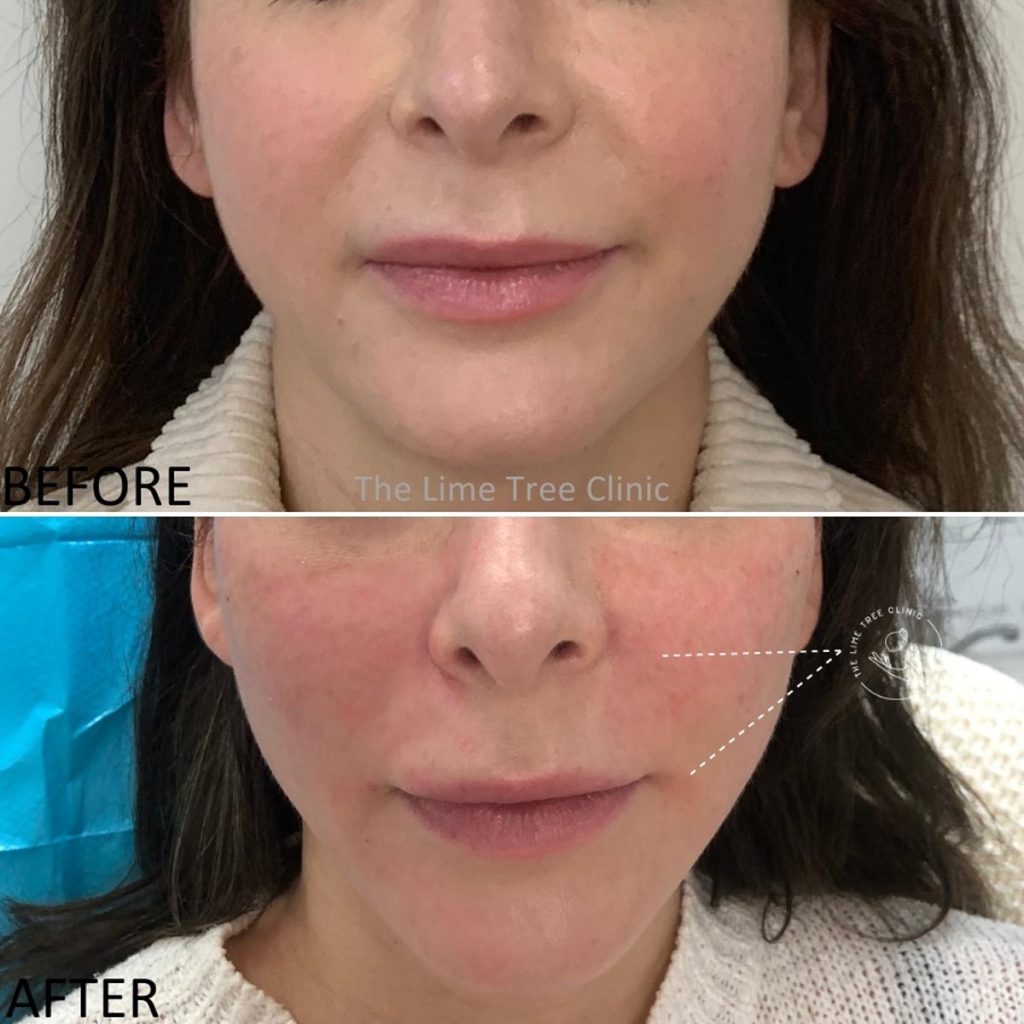 Thread Lift Perth | PDO Non-Surgical Face & Eyebrow Lift